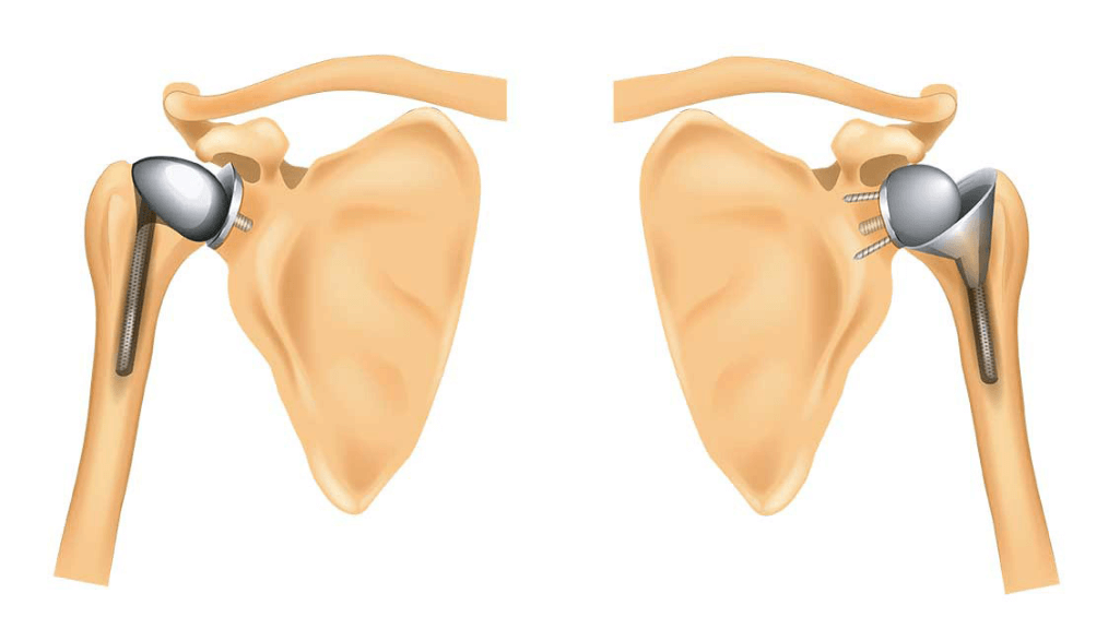 prothèse d'épaule inversée