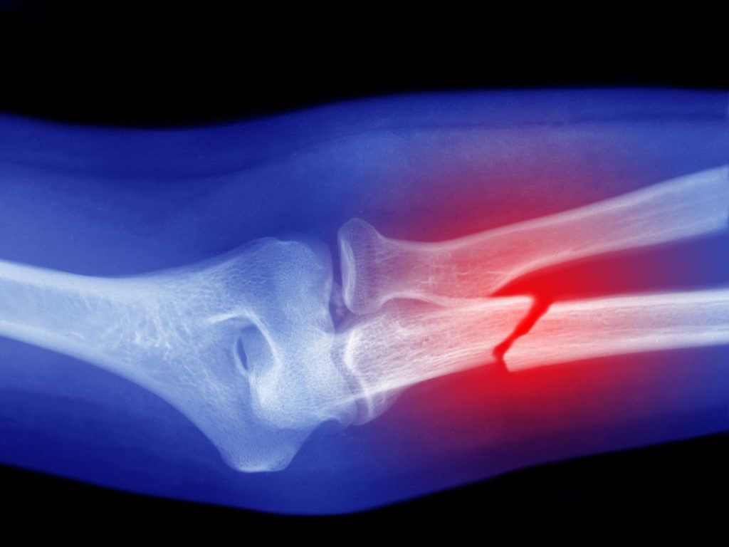 fracture-osseuse-causes-traitements